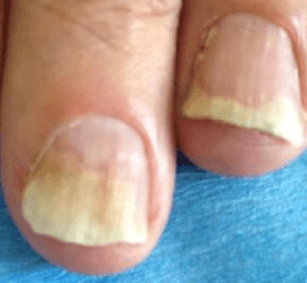 Psoriasis de l'ongle